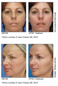 micro laser peel before and after