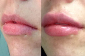 lip enhancement with juvederm