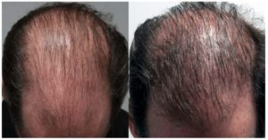 actual patient prp for hair loss before and after picture