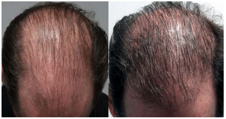 Minneapolis PRP for Hair Loss | Twin Cities Treatment for Thinning Hair