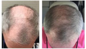 prp for hair loss before and after