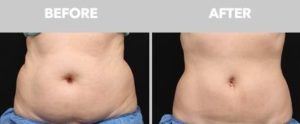 a patient's abdomen showing before and after photos from Coolsculpting; an example of what can be accomplished at Minneapolis Anti-Aging and Skin Clinic.