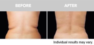 Rear view of coolsculpting results. This shows a before and after, much like what can be accomplished at Minneapolis Skin Clinic.