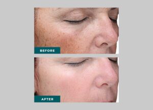 VI-Peels-before-after